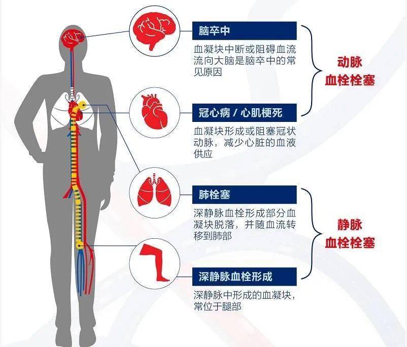 警惕！躺着玩手机引发血栓风险，真实案例深度剖析！